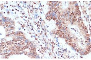 Immunohistochemistry of paraffin-embedded Human colon carcinoma using NAA20 Polyclonal Antibody at dilution of 1:100 (40x lens). (NAT5 抗体)