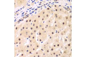 Immunohistochemistry of paraffin-embedded human liver cancer using NFKBIB antibody (ABIN6130475, ABIN6144584, ABIN6144585 and ABIN6221459) at dilution of 1:200 (40x lens). (NFKBIB 抗体  (AA 1-356))