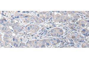 Immunohistochemistry of paraffin-embedded Human breast cancer tissue using RASSF8 Polyclonal Antibody at dilution of 1:35(x200) (RASSF8 抗体)