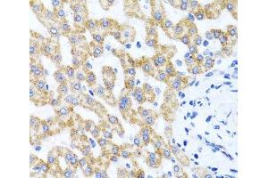 Immunohistochemistry of paraffin-embedded Human liver damage using RIPK4 Polyclonal Antibody at dilution of 1:100 (40x lens). (RIPK4 抗体)