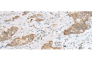 Immunohistochemistry of paraffin-embedded Human esophagus cancer tissue using CALCOCO1 Polyclonal Antibody at dilution of 1:50(x200) (CALCOCO1 抗体)