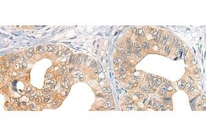 Immunohistochemistry of paraffin-embedded Human gastric cancer tissue using CORO2A Polyclonal Antibody at dilution of 1:45(x200) (CORO2A 抗体)