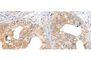 Immunohistochemistry of paraffin-embedded Human gastric cancer tissue using CORO2A Polyclonal Antibody at dilution of 1:45(x200) (CORO2A 抗体)