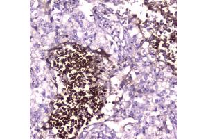 IHC testing of FFPE human lung cancer tissue with Lactoferrin antibody at 1ug/ml. (Lactoferrin 抗体)