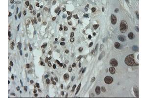 Immunohistochemical staining of paraffin-embedded Adenocarcinoma of breast using anti-IL-3 (ABIN2452543) mouse monoclonal antibody. (IL-3 抗体  (AA 20-152))