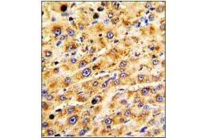 Immunohistochemistry: ADAMTS13 antibody staining of Formalin-Fixed Paraffin-Embedded Human hepatocarcinoma followed by peroxidase-conjugation to the secondary antibody and DAB staining. (ADAMTS13 抗体  (AA 836-866))