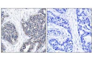 Immunohistochemical analysis of paraffin-embedded human breast carcinoma tissue using Stathmin 1 (Ab-37) antibody (E021218). (Stathmin 1 抗体)