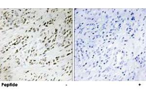 Immunohistochemistry analysis of paraffin-embedded human prostate carcinoma tissue, using TSHZ2 polyclonal antibody .