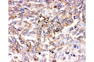 IHC-P: SMAD1 antibody testing of human lung cancer tissue (SMAD1 抗体  (C-Term))