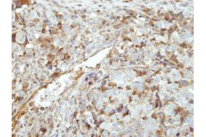 IHC-P Image Immunohistochemical analysis of paraffin-embedded CL1-0 xenograft, using GK5, antibody at 1:500 dilution. (GK5 抗体  (Center))