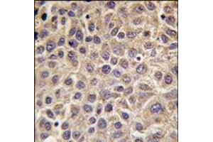 Formalin-fixed and paraffin-embedded human hepatocarcinoma tissue reacted with MTMR8 antibody (C-term), which was peroxidase-conjugated to the secondary antibody, followed by DAB staining. (MTMR8 抗体  (C-Term))