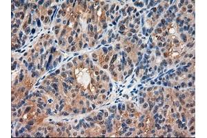 Immunohistochemical staining of paraffin-embedded Carcinoma of kidney using anti-AMY2A (ABIN2452539) mouse monoclonal antibody. (AMY2A 抗体  (AA 300-511))