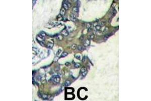 IHC analysis of formalin-fixed and paraffin-embedded human breast carcinoma tissue reacted with MAPK1 Antibody, which was peroxidase-conjugated to the secondary antibody, followed by DAB staining.