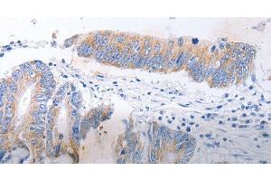 Immunohistochemistry of paraffin-embedded Human colon cancer tissue using SERP1 Polyclonal Antibody at dilution 1:30 (SERP1 抗体)