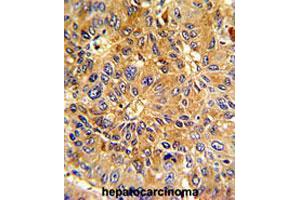 Formalin-fixed and paraffin-embedded human hepatocarcinomareacted with CCNA2 polyclonal antibody , which was peroxidase-conjugated to the secondary antibody, followed by AEC staining. (Cyclin A 抗体  (N-Term))