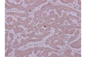 IHC-P Image PCYT2 antibody detects PCYT2 protein at cytoplasm on human breast cancer by immunohistochemical analysis. (PCYT2 抗体)