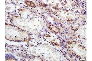 Formalin-fixed and paraffin embedded human colon carcinoma labeled with Anti-CEAcam8 Polyclonal Antibody, Unconjugated (ABIN672651) at 1:200 followed by conjugation to the secondary antibody and DAB staining (CEACAM8 抗体  (AA 51-150))