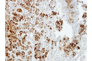 IHC-P Image Immunohistochemical analysis of paraffin-embedded CL1-5 xenograft, using Importin 13, antibody at 1:100 dilution. (IPO13 抗体  (C-Term))