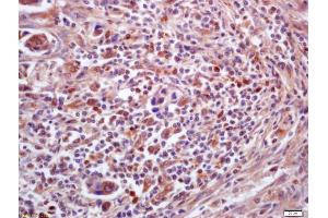 Formalin-fixed and paraffin embedded human lung carcinoma labeled with Anti-PPT1 Polyclonal Antibody, Unconjugated (ABIN718946) at 1:200 followed by conjugation to the secondary antibody and DAB staining (PPT1 抗体  (AA 188-290))