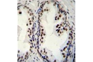 Formalin fixed and paraffin embedded human prsotate carcinoma stained with DDX27 Antibody (C-term) Cat. (DDX27 抗体  (C-Term))