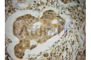 ABIN6267585 at 1/100 staining human breast carcinoma tissues sections by IHC-P. (MDM2 抗体  (pSer166))