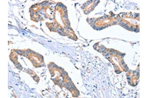 The image on the left is immunohistochemistry of paraffin-embedded Human colon cancer tissue using ABIN7130296(MTMR7 Antibody) at dilution 1/40, on the right is treated with fusion protein. (MTMR7 抗体)