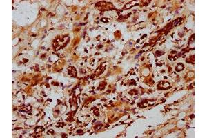 IHC image of ABIN7150368 diluted at 1:1000 and staining in paraffin-embedded human breast cancer performed on a Leica BondTM system. (Id2 抗体  (AA 1-134))