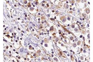 ABIN6273603 at 1/100 staining Human breast cancer tissue by IHC-P. (SLC35C2 抗体  (C-Term))