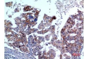 Immunohistochemistry (IHC) analysis of paraffin-embedded Human Ovarian Cancer, antibody was diluted at 1:100.