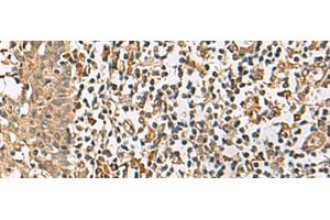 Immunohistochemistry of paraffin-embedded Human tonsil tissue using DCAF12 Polyclonal Antibody at dilution of 1:65(x200) (DCAF12 抗体)
