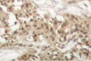 Immunohistochemistry (IHC) analyzes of p-PKC theta antibody in paraffin-embedded human breast carcinoma tissue. (PKC theta 抗体  (pSer676))