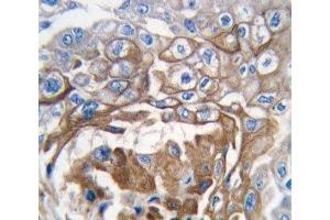 IHC analysis of FFPE human lung carcinoma tissue stained with NRAS antibody (GTPase NRas 抗体  (AA 147-179))