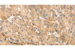 Immunohistochemistry of paraffin-embedded Human liver cancer using EVA1A Polyclonal Antibody at dilution of 1:30 (TMEM166 抗体)
