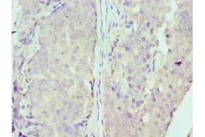Immunohistochemistry of paraffin-embedded human colon cancer using ABIN7150341 at dilution of 1:100 (MCM7 抗体  (AA 360-719))