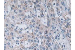 Detection of OAT in Human Lung cancer Tissue using Polyclonal Antibody to Ornithine Aminotransferase (OAT) (OAT 抗体  (AA 1-301))