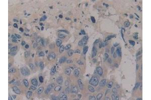 Detection of NPY in Human Breast cancer Tissue using Polyclonal Antibody to Neuropeptide Y (NPY) (NPY 抗体  (AA 30-97))