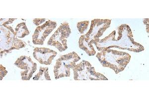 Immunohistochemistry of paraffin-embedded Human thyroid cancer tissue using ABCD1 Polyclonal Antibody at dilution of 1:80(x200) (ABCD1 抗体)