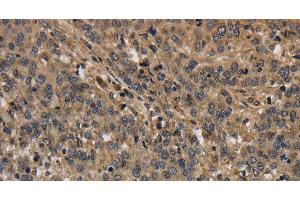 Immunohistochemistry of paraffin-embedded Human liver cancer using KCNN4 Polyclonal Antibody at dilution of 1:40 (KCNN4 抗体)