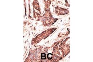 Formalin-fixed and paraffin-embedded human cancer tissue reacted with the primary antibody, which was peroxidase-conjugated to the secondary antibody, followed by AEC staining. (OASL 抗体  (C-Term))