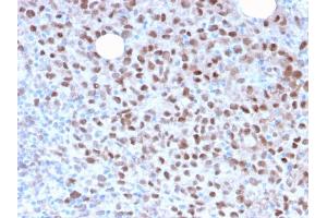 Formalin-fixed, paraffin-embedded human Melanoma stained with MITF Recombinant Rabbit Monoclonal Antibody (MITF/2987R). (Recombinant MITF 抗体)