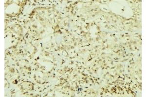ABIN6267064 at 1/100 staining Human breast cancer tissue by IHC-P. (AKT 1/2/3 抗体  (pTyr312, pTyr315, pTyr316))