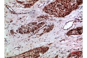 Immunohistochemical analysis of paraffin-embedded human-cervical-cancer, antibody was diluted at 1:200 (Thymopoietin 抗体  (AA 1-50))