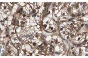 Affinity Purified anti-MAD2L2 antibody shows strong nuclear and cytoplasmic staining of tumor cells in cancerous human kidney tissue. (MAD2L2 抗体  (N-Term))