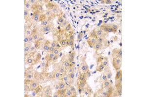 Immunohistochemistry of paraffin-embedded human liver cancer using SULT2B1 antibody. (SULT2B1 抗体  (AA 1-365))