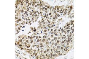 Immunohistochemistry of paraffin-embedded human lung cancer using Smarcd1 antibody (ABIN6003658) (40x lens). (SMARCD1 抗体)