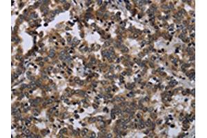 The image on the left is immunohistochemistry of paraffin-embedded Human liver cancer tissue using ABIN7129488(FGF18 Antibody) at dilution 1/20, on the right is treated with fusion protein. (FGF18 抗体)