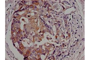 Immunohistochemistry of paraffin-embedded human breast cancer using ABIN7154605 at dilution of 1:100 (Adenylate Kinase 3 抗体  (AA 142-227))
