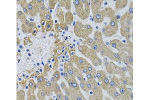 Immunohistochemistry of paraffin-embedded Human liver damage using MBL2 Polyclonal Antibody (MBL2 抗体)