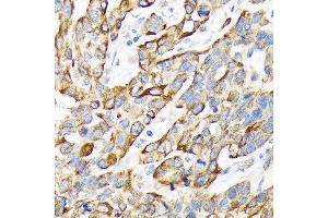 Immunohistochemistry of paraffin-embedded human esophageal cancer using Cytokeratin 16 (KRT16) Rabbit mAb (ABIN7268094) at dilution of 1:100 (40x lens). (KRT16 抗体)