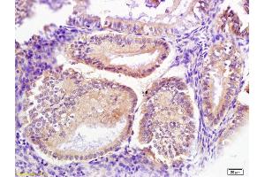 Formalin-fixed and paraffin embedded human endometrium carcinoma labeled with Anti-Signal recognition particle Polyclonal Antibody, Unconjugated (ABIN680228) at 1:200 followed by conjugation to the secondary antibody (Signal Recognition Particle (AA 401-500) 抗体)